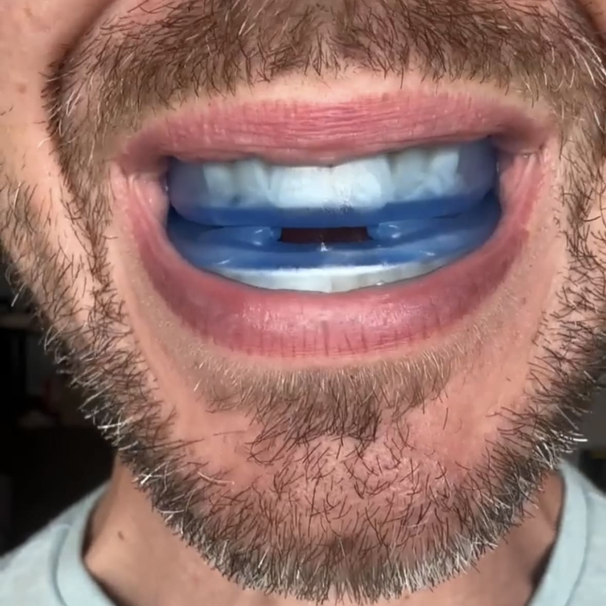 Premium Anti-Snoring Mouthpiece: Adjustable, Comfortable, Effective Solution for Quiet Sleep